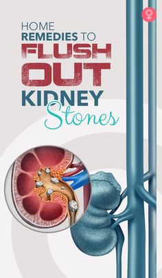 Help Passing A Kidney Stone, What To Eat For Kidney Health, Kidney Stone Natural Remedy, How To Remove Stones From Kidney, Natural Remedies For Kidneys, Kidney Stone Cleanse, Kidneystone Natural Remedies, Kidney Remedies Natural, Natural Remedies For Kidney Stone Pain