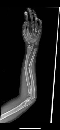 an x - ray shows the arm and wrist bones