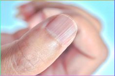 White Lines On Nails, Fingernail Ridges, Nail Health Signs, Fingernail Health, Nail Ridges, Nail Room Ideas, Nail Problems, Nail Room, Lines On Nails