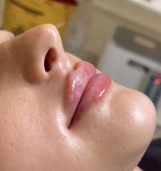 Lip Fillers Juvederm, My Future Job, Future Jobs, Hot Lips, Lip Fillers, Med Spa, Nose Piercing, Background For Photography