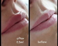 Lip Filler 5ml, Lip Filler Inspo 0.5ml, Lip Fillers Inspiration, Top Lip Filler