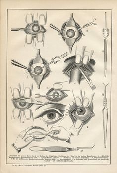 an old medical illustration shows the eye and utensils