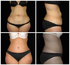 Tummy tuck surgery is a transformative procedure for women who have failed to regain their abdominal tone after pregnancy or dramatic weight loss. Dancer Workout, Cleanse Your Body, Tummy Tucks, After Pregnancy, Health Benefits, Surgery