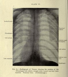 an old book with some diagrams about the chest and thorbones in black and white