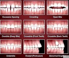 Cooperative Dental Crown Metals #dentalImplants #DentalCrownMouths Parenting Charts, Dental Hygiene School, Dental Veneers, Pediatric Dentistry, Dental Insurance, Dental Problems, Dental Hygienist