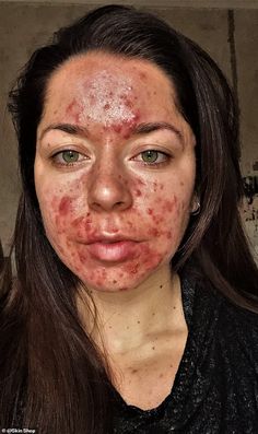 Personal trainer who had the 'worst acne ever seen' shares her striking before and after pictures Acne Pictures, Before And After Acne, Face Mapping Acne, Blind Pimple, Bad Acne, Natural Acne Remedies, Severe Acne, How To Get Rid Of Pimples, Face Acne