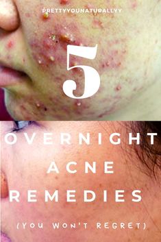 ways in treating the skin from pimples Overnight Acne Remedies, Clear Complexion, Acne Remedies, Free Snacks, Fresh Linen, Skin Care Treatments, The Skin, Clear Skin, Glowing Skin