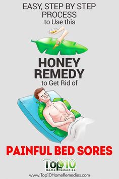 Here, a physician takes you through the different stages, risk factors and complications related to bedsores, and shares some tips to help them heal. Sore Joints Remedies, Honey Remedies, Headache Relief Instant, Joints Pain Remedy, Bed Sores, Top 10 Home Remedies, Natural Headache Remedies, Petroleum Jelly, Joints Pain Relief