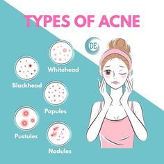 Jenis Jerawat, Skincare Blogger, Types Of Acne, Skincare Review, Luxury Skincare, Skin Care Regimen, Skin Care Tips, Skin Care Routine, Skin Care