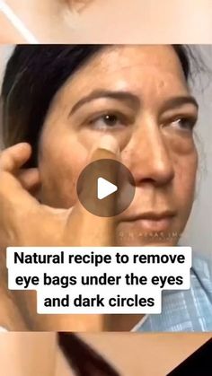 Undereye Bags Remedy, Eye Bag Remedies, Eye Health Remedies, Eye Bags Makeup, Puffy Eyes Remedy, Remove Eye Bags, Dark Eye Circles, Brown Spots Removal, Eye Exercises