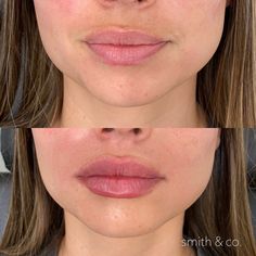 Lip Filler Before And After 1ml, Lip Fillers Before And After 1ml, Facial Poses, Lips Injection, Lip Filler Technique, 1ml Lip Filler