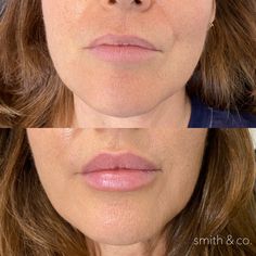 Lip Flip, Botox Filler