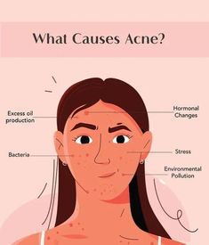 Acne can be caused by a variety of factors, from hormonal changes and stress to clogged pores and bacteria. Understanding the root causes is the first step toward effective treatment. Discover common triggers and tips to prevent breakouts for clearer, healthier skin. Save this pin to learn how to tackle acne at its source! 🍁🌟#skincare #skincarecommunity#skincareacne#skinhealth#faceless #faceless #face#beautyblog #beautyroutine#beautylovers #glowing #glowingskintips