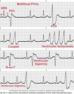 Pvc Heart Rhythm, Nremt Paramedic Test Prep, Pima Medical Institute, Mental Tips, Sinus Rhythm, Paramedic Student, Heart Rhythm