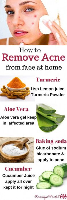 ✅Many natural ways to how to pimples remove from face get rid of ✅ Home remedies for pimple, how to remove dark spots by pimple marks remover Doterra Acne, Remove Acne Marks, Home Remedies For Pimples, Brown Spots On Skin, Pimple Scars, Pimples Overnight, Pimples Remedies, Skin Care Routine For 20s, Natural Acne Remedies