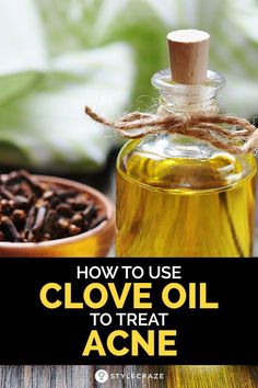 Clove oil for acne is a remedy that has been used for generations to treat pimples, minimize scars and reduce dark spots from acne without drying the skin. Clove Oil, Treat Acne, Coconut Oil For Skin, Acne Remedies, How To Treat Acne, Face Scrub, Oils For Skin