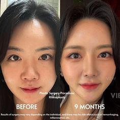 Change Appearance, Nose Job, Korean Makeup, Kylie Jenner, Korean Drama