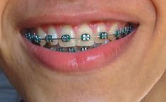 Dark Green Braces, Green Braces, Jewelry Teeth, Teeth Gems