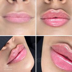 Heart Lip Filler, Lip Fillers Heart Shape, Angelic Lip Filler, Heart Shaped Lip Filler, Hyaluronic Lips, Filled Lips, Desired Lips, Juvederm Lips