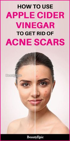 Brown Spots On Skin, Skin Care Routine For 20s, Dark Spots On Face, Get Rid Of Acne, Rid Of Acne, Natural Acne Remedies, Brown Spots Removal, Brown Spots On Face, Treat Acne