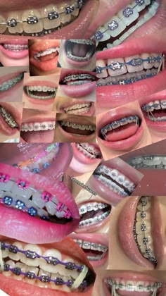 Perfect Teeth Braces, Brace Colors, Power Chain Braces, Dental Braces Colors, Braces Colors Combinations, Braces Colours, Pink Braces, Braces Ideas, Cute Braces Colors