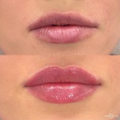 1ml Lip Filler, Restylane Lips, Face Injections, Derma Fillers, Lip Permanent Makeup, Permanente Make-up