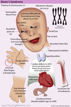 an info poster showing the stages of down's syndrome and how to treat them