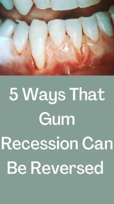 Tooth Decay Remedies, Dental Health Care, Gum Recession, Teeth Health, Receding Gums, Gum Care, Gum Health, Teeth Care, Oral Health Care