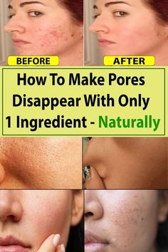 Big Pores On Face, Minimize Pores Naturally, Wrinkle Remedies, Exercise Tips, Skin Pores, Deep Wrinkles, Minimize Pores, Best Anti Aging