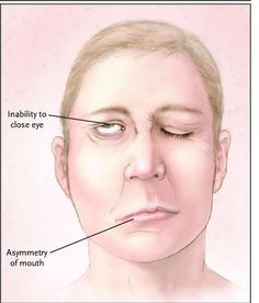 What is Bell’s Palsy? Bell’s Palsy, also known as idiopathic facial palsy, is the most common cause of facial paralysis, affecting about 40 000 people each year in the US alone. Although It can affect anyone of any gender and age, it most commonly occurs in individuals between ages 15 and 45. The facial paralysis results in the temporary inability to control the facial muscles on the affected side of the face and involves the dysfunction of the cranial nerve VII (Facial nerve) which controls... Side Of Face, Muscles Of The Face, Bells Palsy, Facial Nerve, Muscle Weakness, Facial Muscles, Romantic Drama, Dry Eyes, Neurology