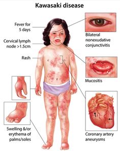 Kawasaki Disease Nursing 101, Medical Mnemonics, Nclex Pn, Nclex Prep, Student Info, Nursing School Motivation, Medical School Life, Nursing Mnemonics