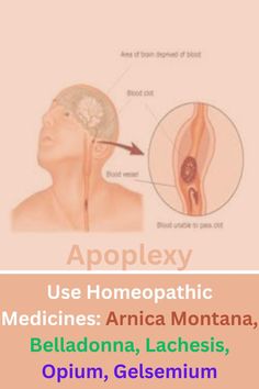 Homeopathic Medicines for Apoplexy Nose Problems, Mouth Problems, Neck Problems, Medical Emergency, Stomach Problems, Blood Vessels