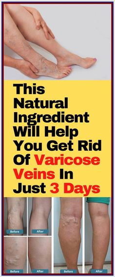 This Natural Ingredient Will Help You Get Rid Of Varicose Veins In Just 3 Days! Beginner Full Body Workout, Healthy Style, Women Health Care, Ways To Be Happier, Senior Health, Healthy Benefits, Take Care Of Your Body