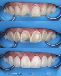 Tooth Surfaces, Occlusion Dental, Teeth Composite, Dental Composite, Composite Veneers, Complete Denture Prosthodontics, Dental Videos