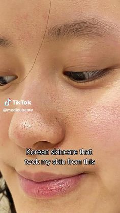 Remove Blackheads From Nose, Blackheads On Nose, Clean Blackheads, Basic Skin Care Routine, Natural Sleep Remedies, Clear Skin Tips, Perfect Skin Care Routine, Sheet Masks, Get Rid Of Blackheads