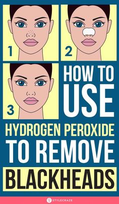 Hydrogen peroxide is the universal go-to ingredient when it comes to skincare. Read this article to how to use hydrogen peroxide to remove blackheads safely. To Remove Blackheads, Natural Cold Remedies, Get Rid Of Blackheads, Natural Cough Remedies