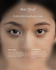 Tau gak sih kalau kantung mata dan mata panda itu dua hal yang berbeda loh! Supaya lebih tau perbedaannya, coba swipe post di atas ini ya👆 Tapi, solusinya gak usah banyak-banyak loh, kamu cukup pakai Skin Dewi Horse Chestnut Dark Circle Eye Serum untuk bantu rawat area kulit matamu secara menyeluruh! Eye serum satu ini juga dilengkapi dengan aplikator Electric Vibration yang bantu untuk lancarkan sirkulasi darah di area kulit mata dan berikan efek relaksasi✨ #ConfidentinYourOwnSkin #SkinDewi Kantung Mata, Horse Chestnut, Feed Ig, Dark Circle, Eye Serum, Serum, Beauty, Quick Saves