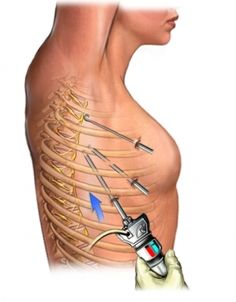 Thoracic Endometriosis on lungs & more. Varicose Vein Removal, Crps Awareness, Homemade Facial Mask, Support Groups, Pelvic Pain, Healthy Benefits, Healthy Routine, Lungs