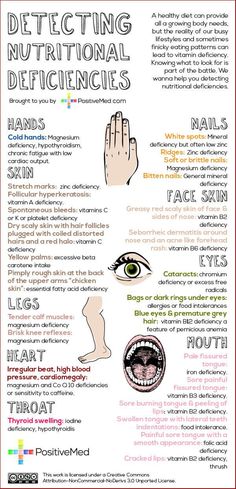 Nutritional Deficiencies, Body Health, Holistic Health, Healthy Body, Health And Nutrition