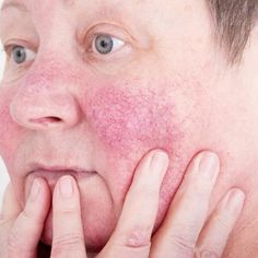 Rosacea is a common chronic skin condition that affects millions of people worldwide, 2-3% of the population in the United States alone. Although rosacea is common, the exact cause of rosacea is still unclear, but it is …. Skin Redness, Natural Treatments, Oils For Skin, Skin Conditions, Facial Care, Beauty Care, Clear Skin, Natural Skin, Natural Skin Care