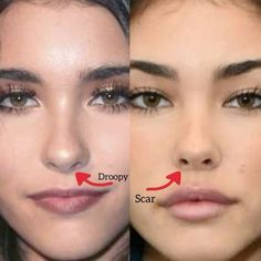 Nose Job And Lip Fillers, Botox And Fillers Before After, Madison Beer Nose, Chin Fillers Before After, Nose Job Before And After, Botox Lip Flip, Filler Face, Nose Plastic Surgery