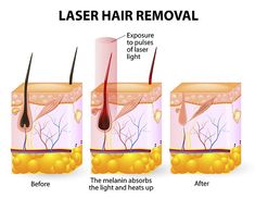 Laser Hair Removal Cost, Laser Hair Reduction, Best Hair Removal Products, Ipl Laser Hair Removal, Hair Growth Cycle, Laser Hair Removal Device, Laser Clinics, Ipl Laser, Hair Removal Methods