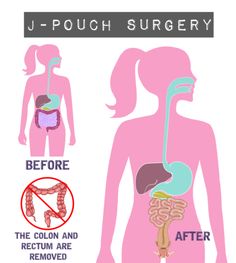 What Exactly is A J-Pouch? - Inflamed and Untamed