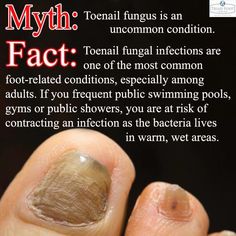 Toenail Fungal Infection, Face Pores, Nail Fungus Remedy, Ingrown Toenail, Health Guru, Fungal Nail, French Tip Acrylic Nails, Ingrown Toe Nail, French Acrylic Nails