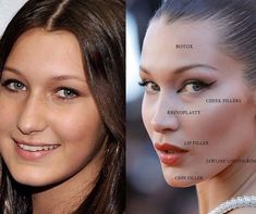 Celebrity Surgery, Plastic Surgery Fail, Rhinoplasty Nose Jobs, Botox Lips, Plastic Surgery Gone Wrong, Face Surgery, Cheek Fillers, Facial Surgery, Facial Fillers