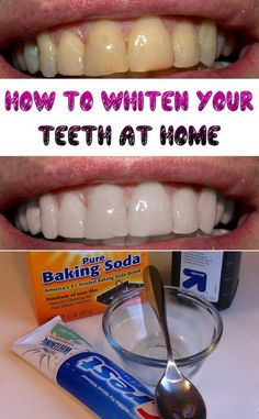 Drinking soda, wine, coffee, smoking, and eating highly pigmented foods–all these can stain our teeth. So some people would spend hundreds of dollars to visit their dentist for a quick whiten… White Teeth Diy, Make Teeth Whiter, Whiten Your Teeth At Home, Teeth Whitening Homemade, Teeth Whitening Remedies, Teeth Whitening Diy, Diy Teething, Whiten Your Teeth, Teeth Whitening Strips