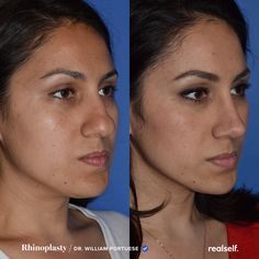 Long Nose Rhinoplasty, Bulbous Nose Job, Nose Job Bulbous Tip, Nose Job Before And After Bulbous, Rhinoplasty Before And After Bulbous, Bulbous Tip Rhinoplasty, Bulbous Nose Rhinoplasty Before After, Nose Job Before And After, Ethnic Nose Job