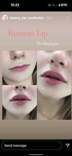 Top Heavy Lip Filler, Hollywood Lips Filler, Russia Lip Filler, Lip Injections Aesthetic, Round Lips Aesthetic, Round Lips Filler, M Shaped Lips, Korean Lip Filler