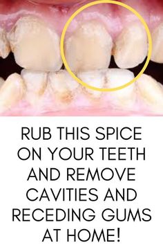 Rub this spice on your teeth and remove Cavities and receding Gums at home!!🔥 Remedies For Tooth Ache, Hygiene Care, The Teeth