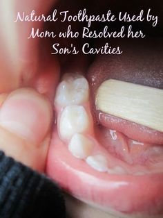 Healing Cavities, Natural Toothpaste, Oil Pulling, Diy Remedies, Natural Therapy, Homemade Remedies